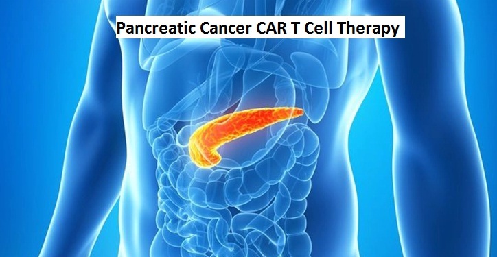 Pancreatic Cancer CAR T Cell Therapy and Precision Treatment Innovations in China