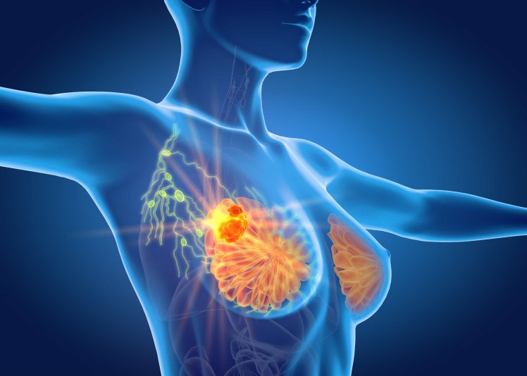Latest Breast Cancer Treatments in China | A New Era in Precision Oncology