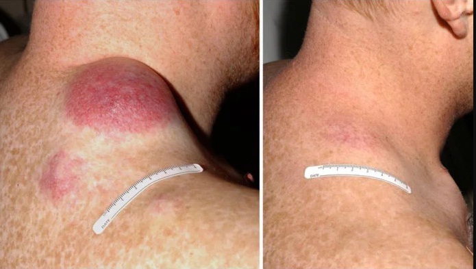 Фотографии до и после пациента с прогрессирующей меланомой, прошедшего TIL-терапию. Источник: Национальный институт рака.